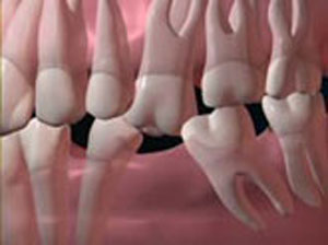 بریج‌های دندانی