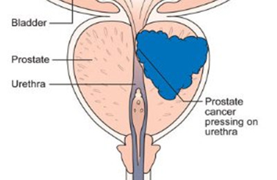 راه های تشخیص قطعی سرطان پروستات