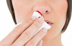 خونریزی بینی در بارداری خطرناک است؟