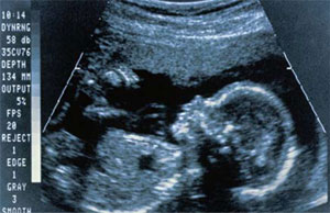 سونوگرافی؛ نه فقط برای تعیین جنسیت جنین