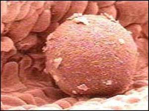 تشخیص زود‌هنگام سرطان تخمدان