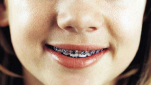 سلامت دندان شیری ضامن سلامت دندان دائمی است