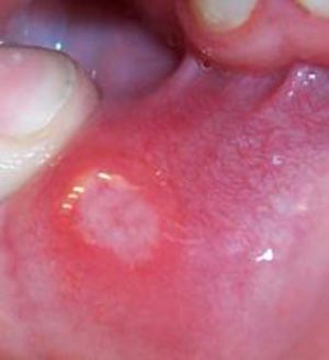 زخم دهان در بیماران سرطانی