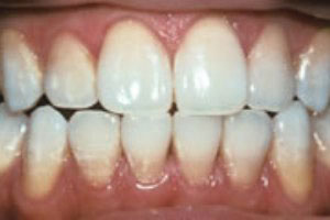 مهمترین عامل زرد شدن دندان‌ها