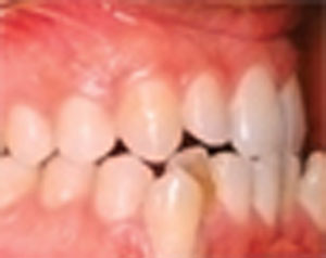 آنچه باید درباره ایمپلنت های دندانی بدانید