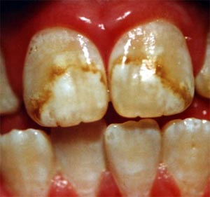 فلوروزیس دندانها
