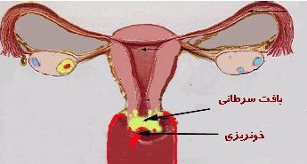 درد مچ پا