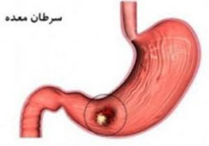 سرطان معده و ریسک فاکتورهای ابتلا به آن