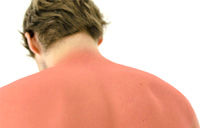 ۵ راه حل برای درمان آفتاب سوختگی