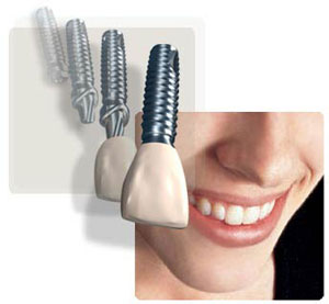 جایگزین کردن یک دندان آسیا با ایمپلنت