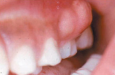 علل آبسه دندان و راه درمان آن
