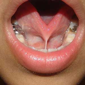 چسبیدن زبان به کف دهان