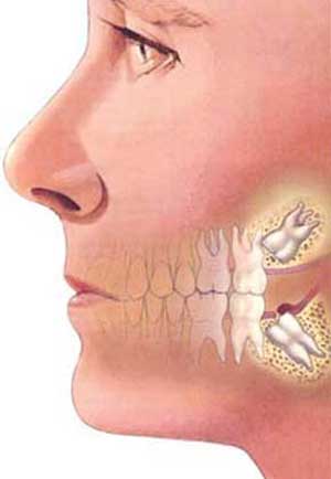 مشکلات دندان عقل