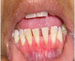 سرطان دهان در کمین آقایان بالای ۵۰ سال