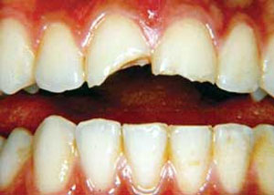 آسیب‌های دندانی