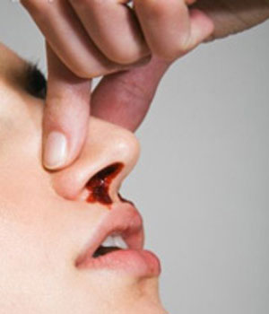 ساده ترین راه جلوگیری از خونریزی بینی