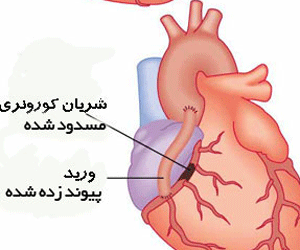 جراحی بای‌پس عروق کورونر قلب چیست؟
