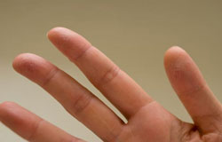 چرا انگشت هایم پوسته پوسته شده اند؟