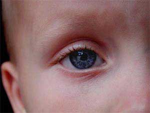 هرگز چشم‌های کودکان را لیزیک نکنید