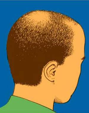 ارتباط ریزش موی سر در آقایان با حملات قلبی