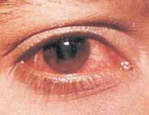 رفع خشکی و التهاب چشم