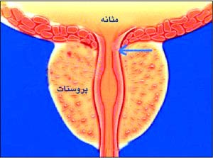 علائم سرطان پروستات