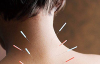 آیا طب سوزنی برای درمان گردن درد موثر است؟