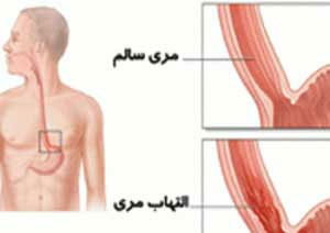 چرا مری ملتهب می شود؟