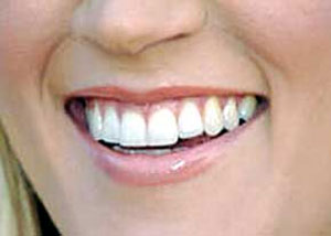 ردیف کردن دندان‌ها بدون ارتودنسی