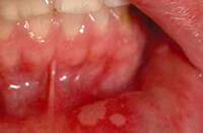 توصیه‌هایی برای درمان سریع‌تر زخم‌های دهان