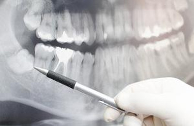 بهترین سن برای جراحی دندان عقل را می دانید؟