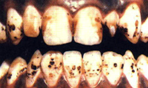پوسیدگی دندان چرا و چگونه