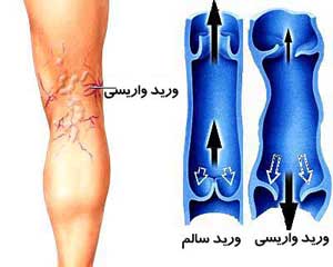 علل و علائم واریس