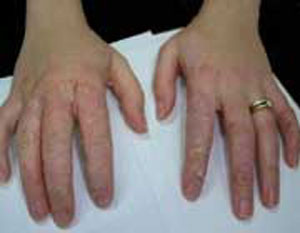 توصیه های مهم به بیماران مبتلا به اگزما یا حساسیت دست