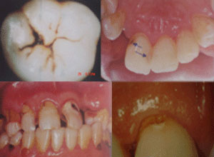 مراحل پیشرفت پوسیدگی دندان