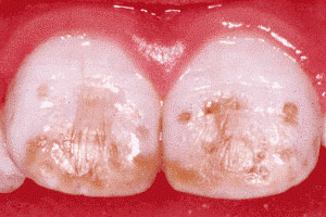 لکه‎های دندان چگونه ایجاد می‎شوند؟