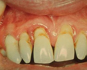 چند عادتی که به تشکیل پلاک روی دندان منجر می‌شود