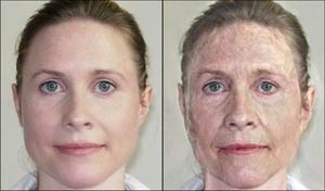 لیزر و کاربرد آن در درمان بیماریهای پوستی و زیبایی پوست