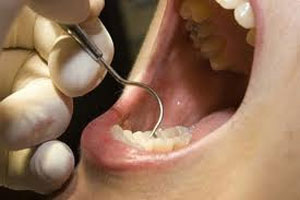 اگر دندانتان را تازه پُر کردید...