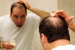 ارتباط ریزش مو با ابتلا به سرطان پروستات