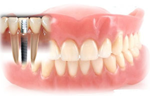برطرف کردن لقی دندان های مصنوعی با استفاده از ایمپلنت