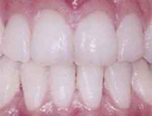 انواع سفیدکننده‌های دندان
