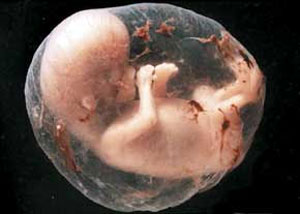 دلایل سقط جنین