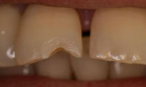 دندان قروچه یا ساییدگی دندان