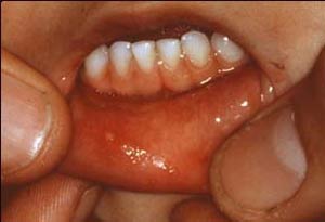 زخم‌های دهان Mouth ulcers