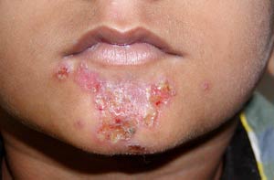 زرد زخم Impetigo