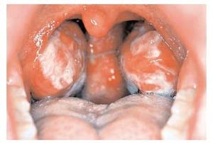 تب غده‌ای Glandular fever