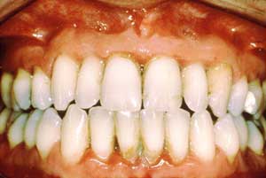 چگونه از زود افتادن دندانهای شیری و رویش نادرست دندانهای دائمی جلوگیری كنیم ؟
