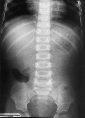 انواژیناسیون Intussusception