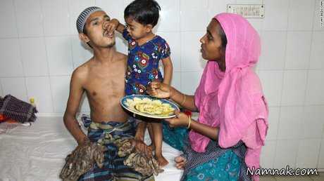 مرد درختی بنگلادش زیر تیغ جراحی + تصاویر